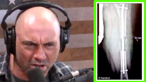 what medical condition does joe rogan suffer from